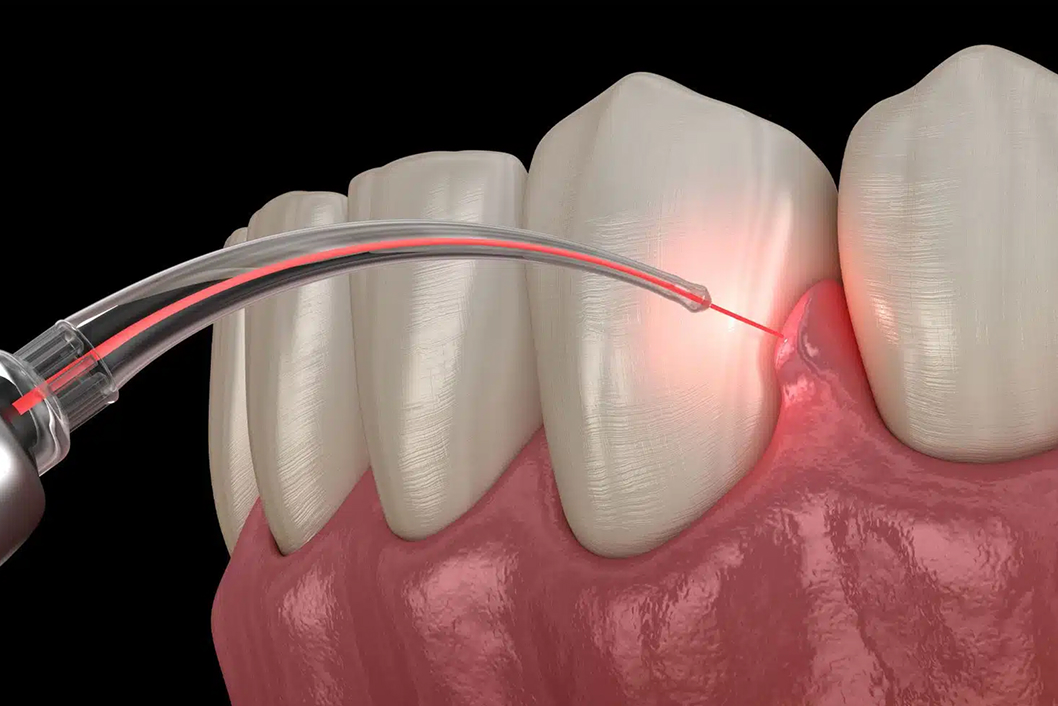 Gum Surgery with Laser